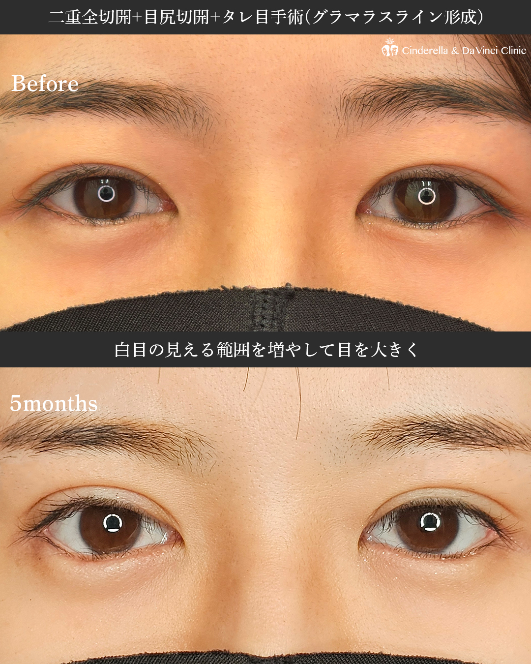 白目の範囲を増やすの画像