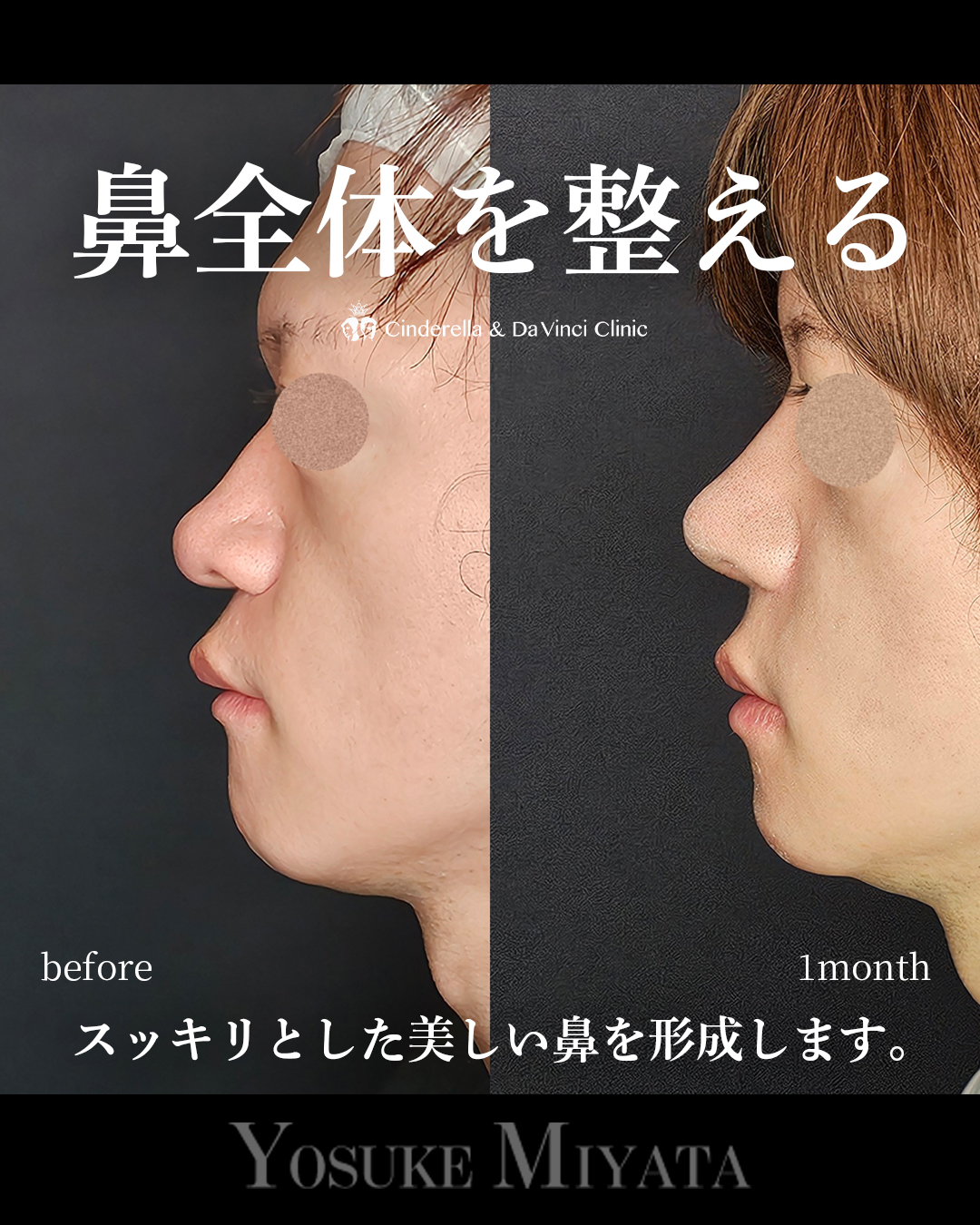 鼻全体を整えるの画像