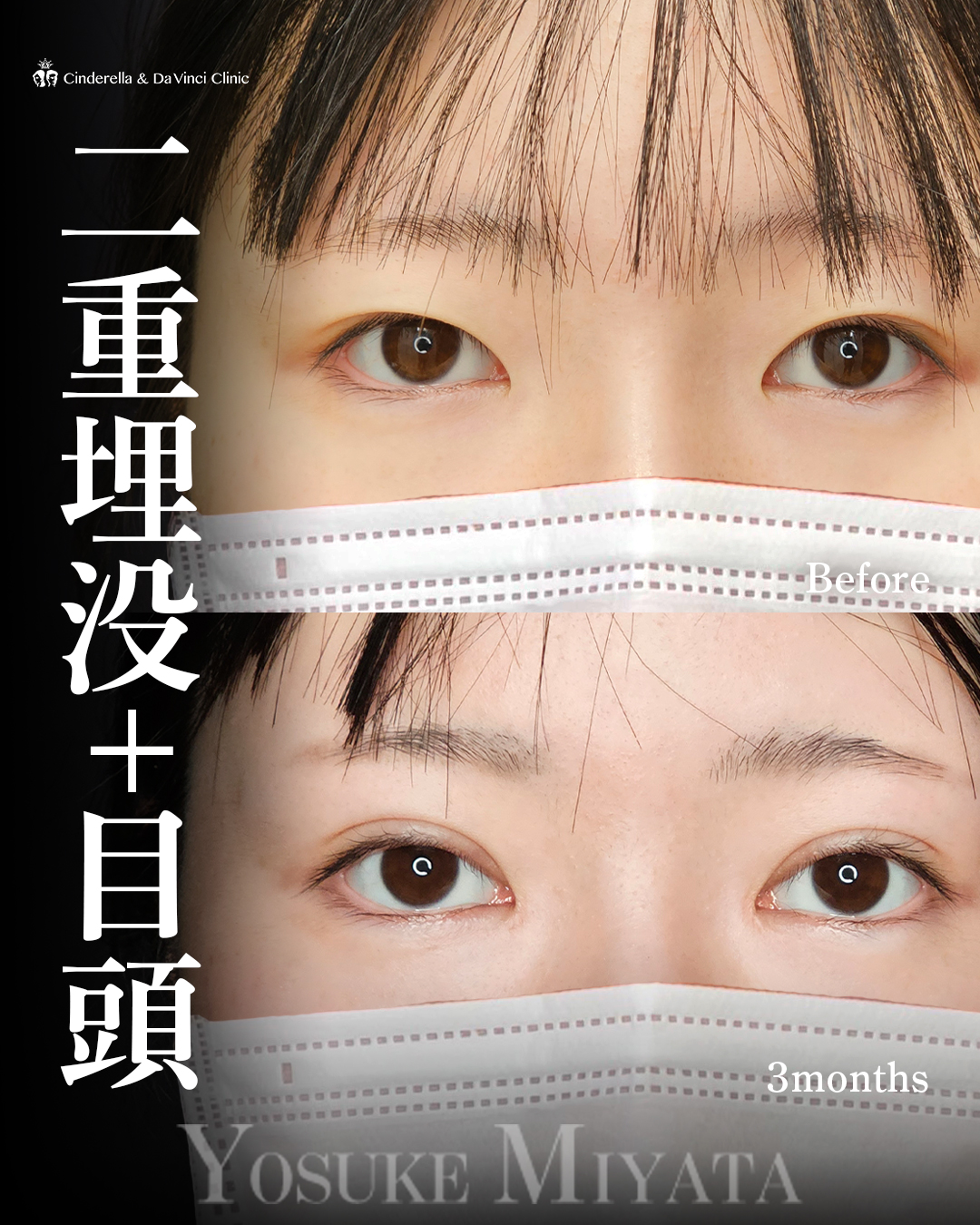 華やか二重の画像