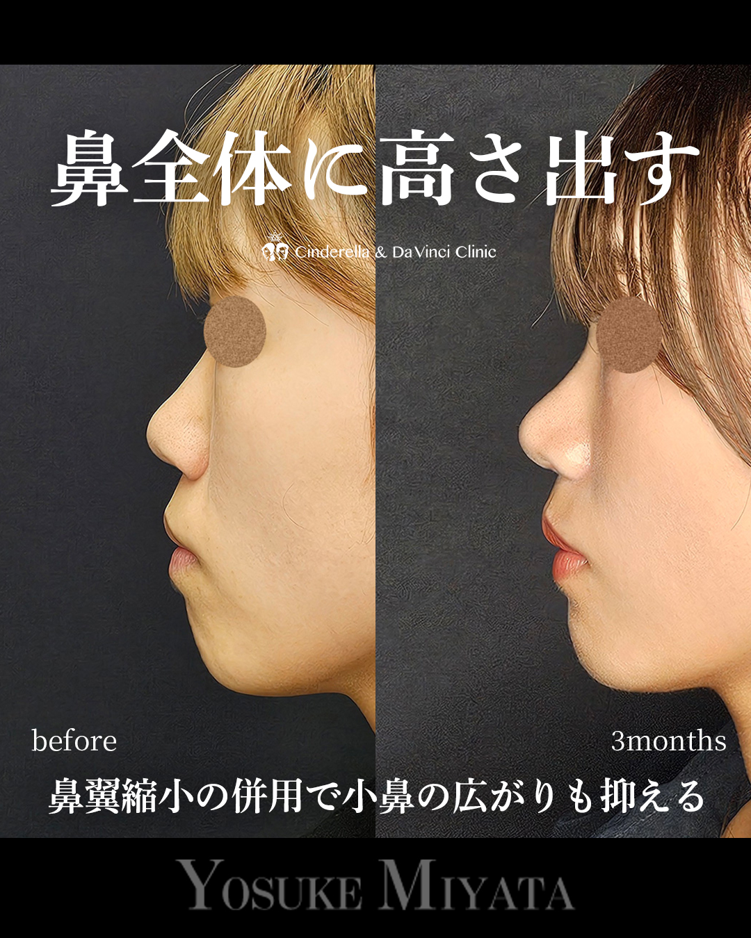 鼻全体に高さ出すの画像