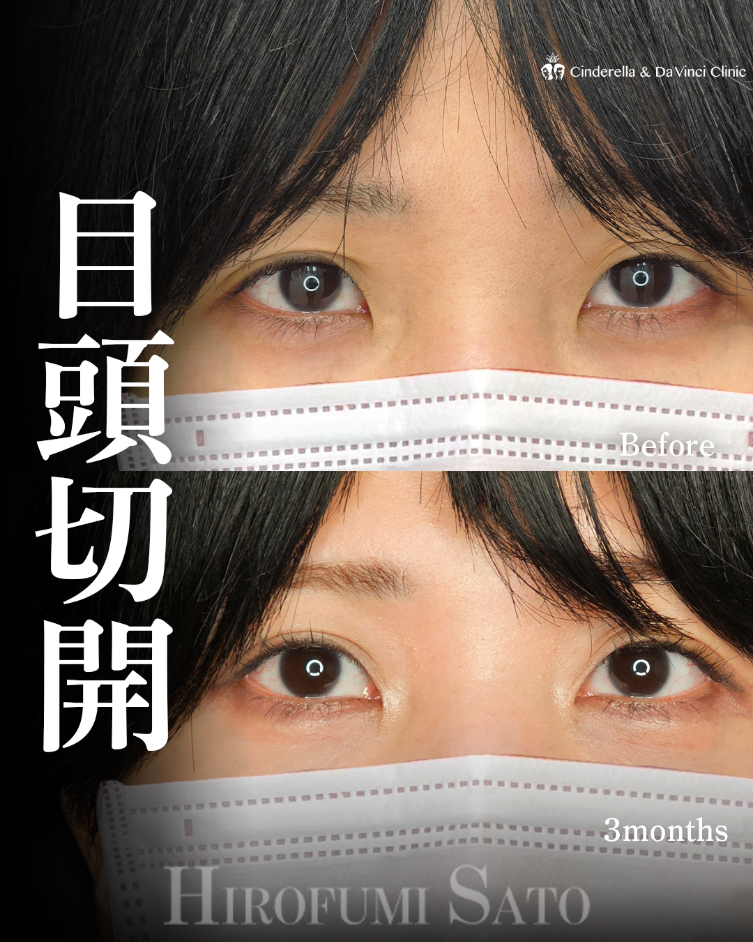 離れ目改善の画像