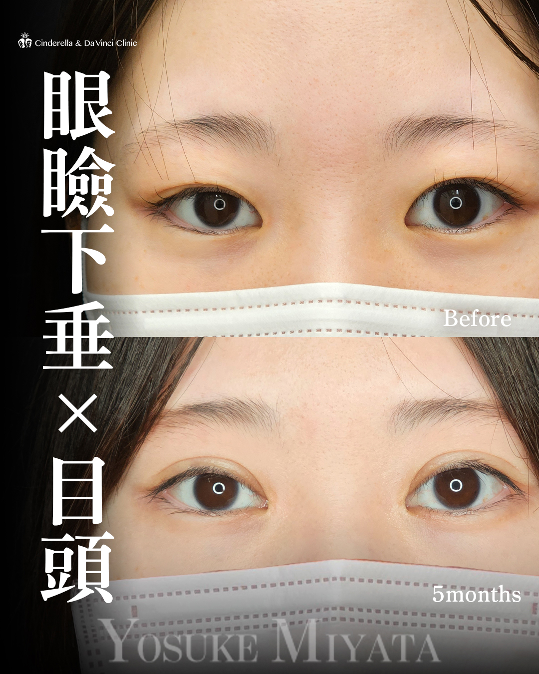 目の開きをよくするの画像