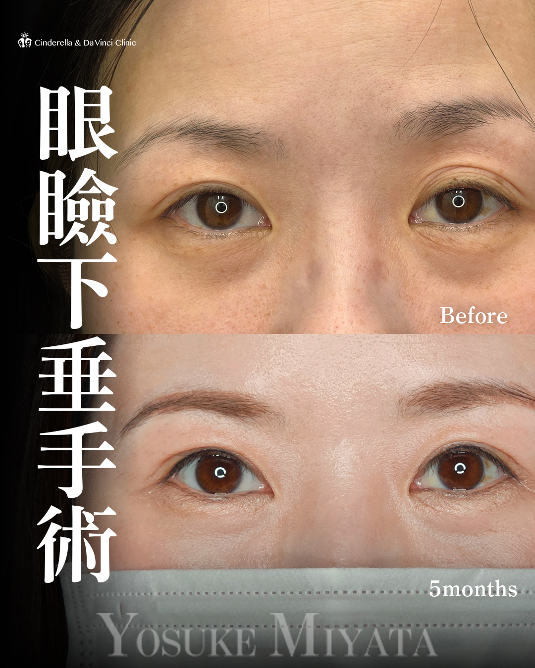 眼瞼下垂手術の画像