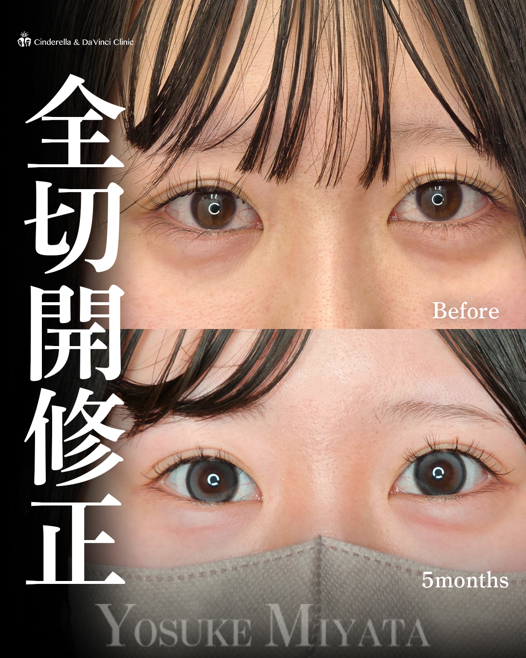 二重全切開の修正の画像