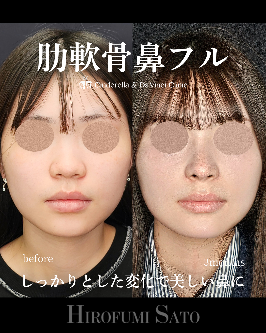 肋軟骨鼻フルの画像