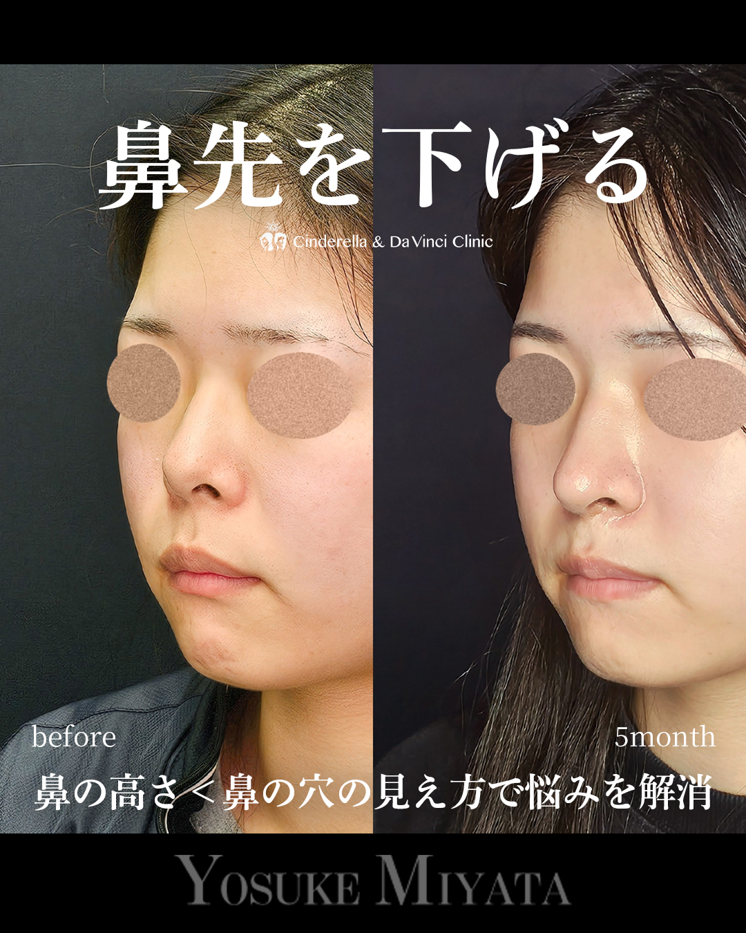 鼻先を下げるの画像