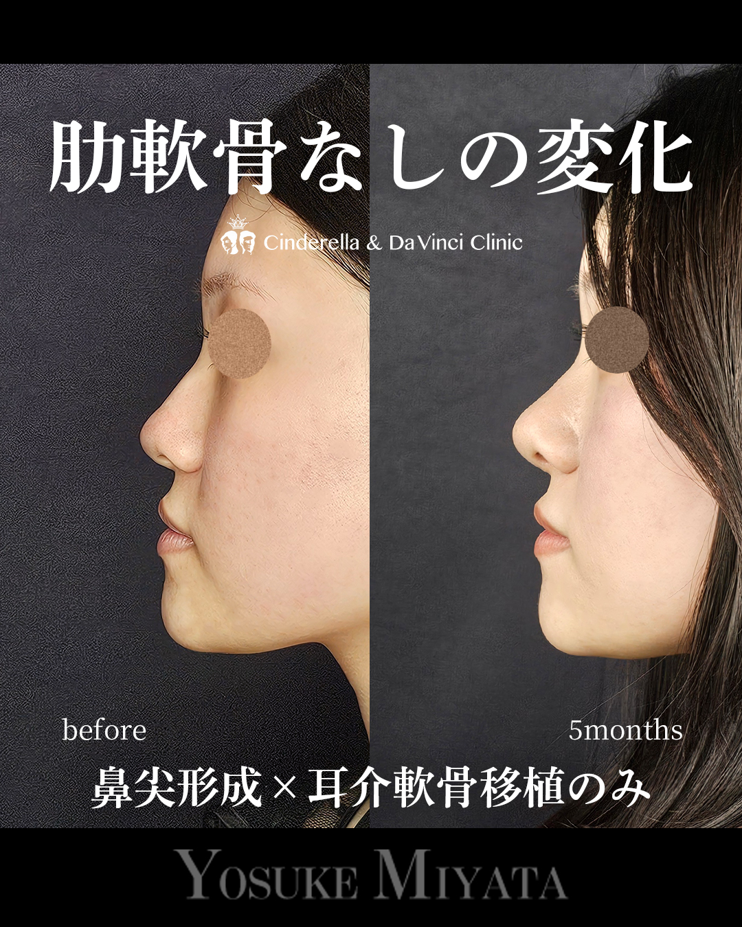 肋軟骨なしの鼻整形の画像