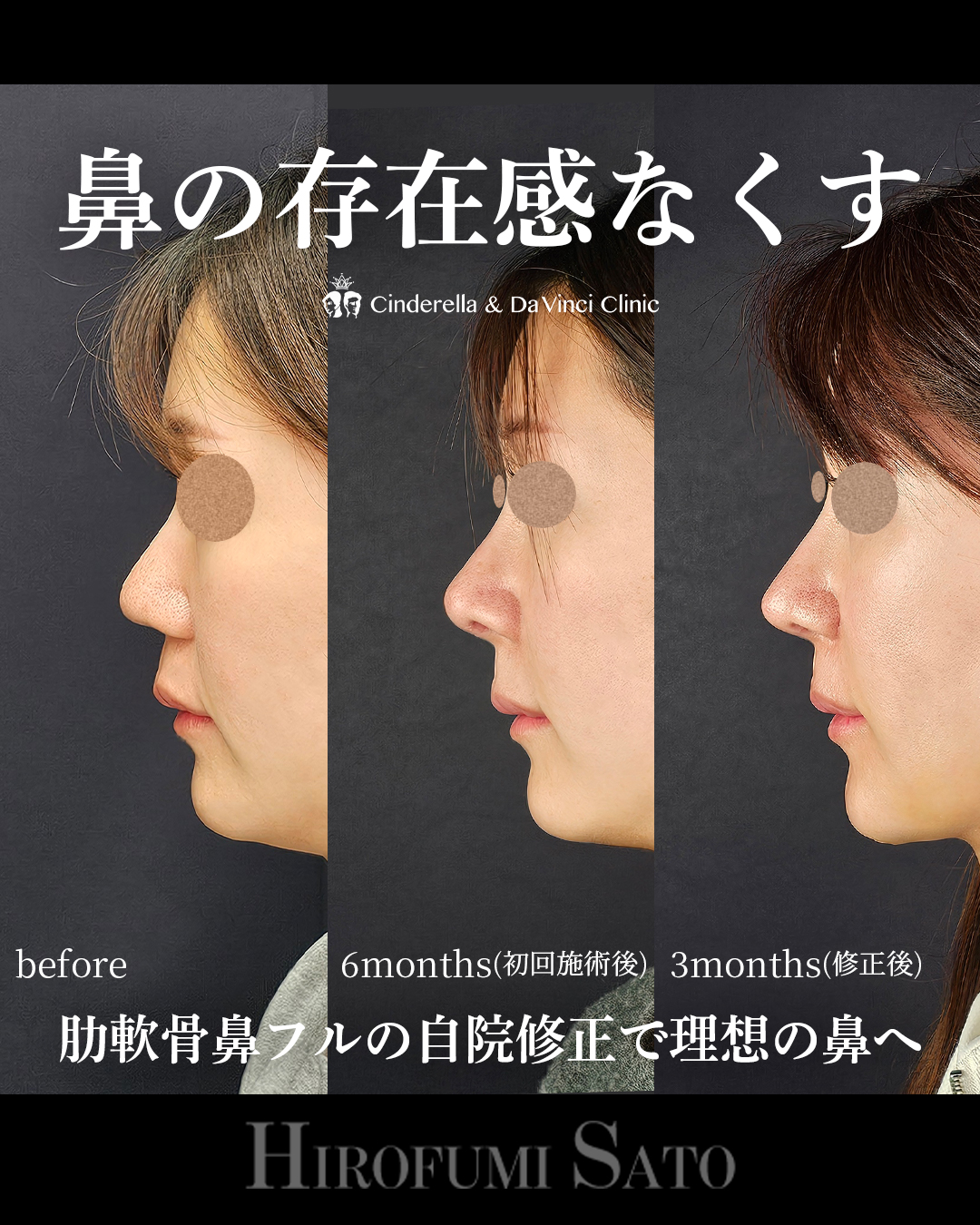 鼻全体を整えるの画像