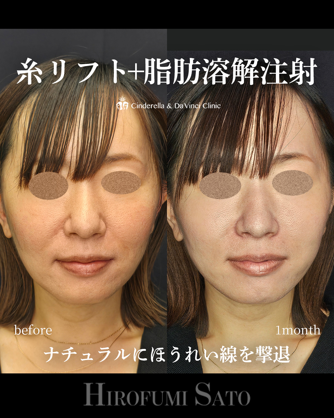 ほうれい線撃退の画像