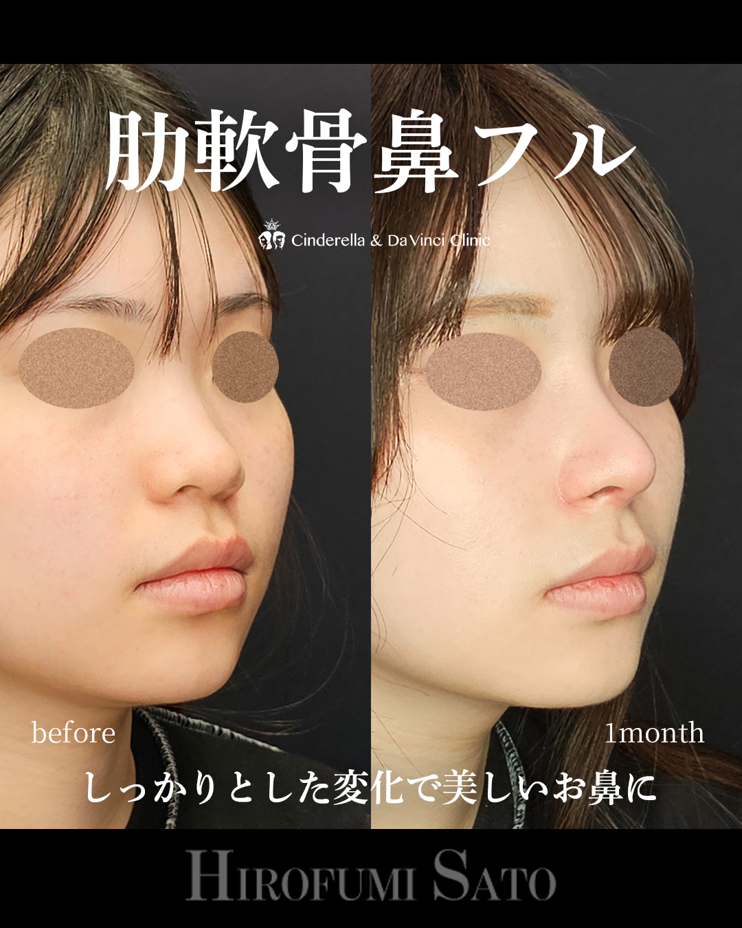 肋軟骨鼻フルの画像