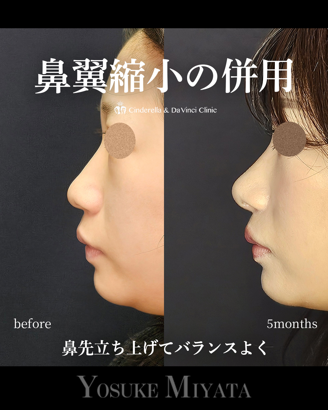 鼻の広がりを抑えるの画像