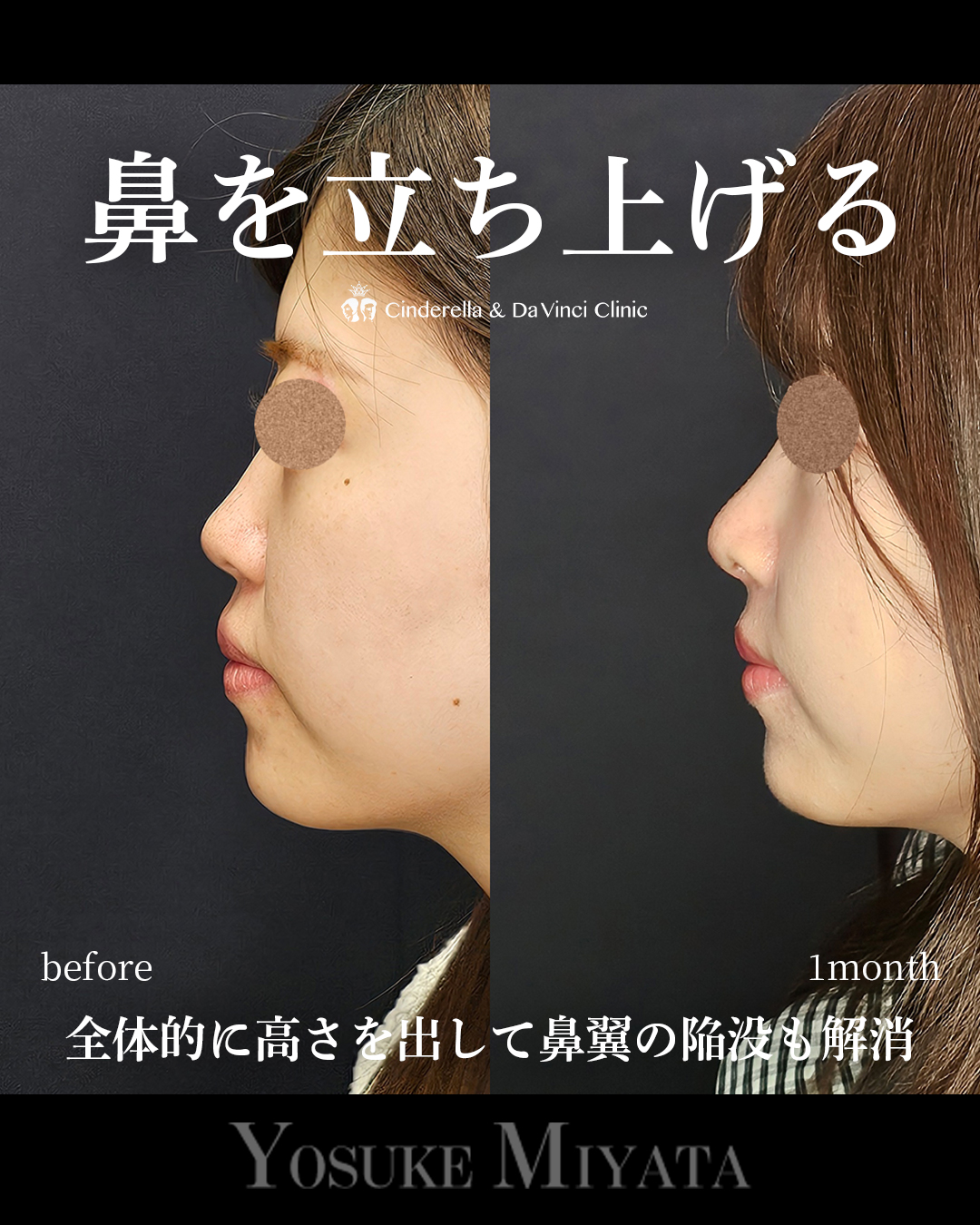 鼻を立ち上げるの画像