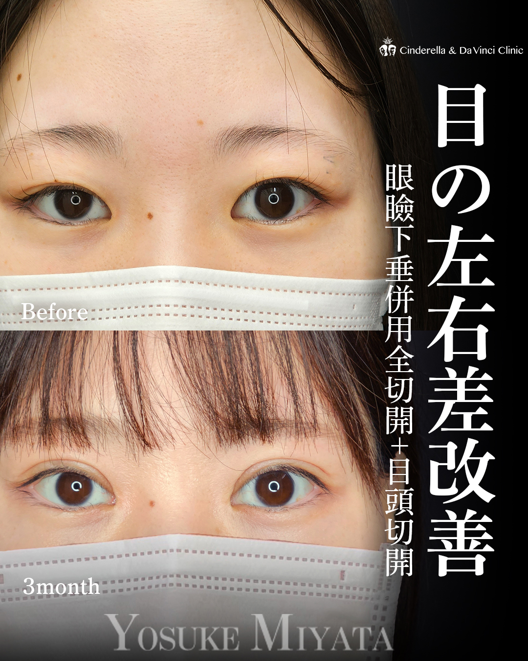 目の開きをよくするの画像