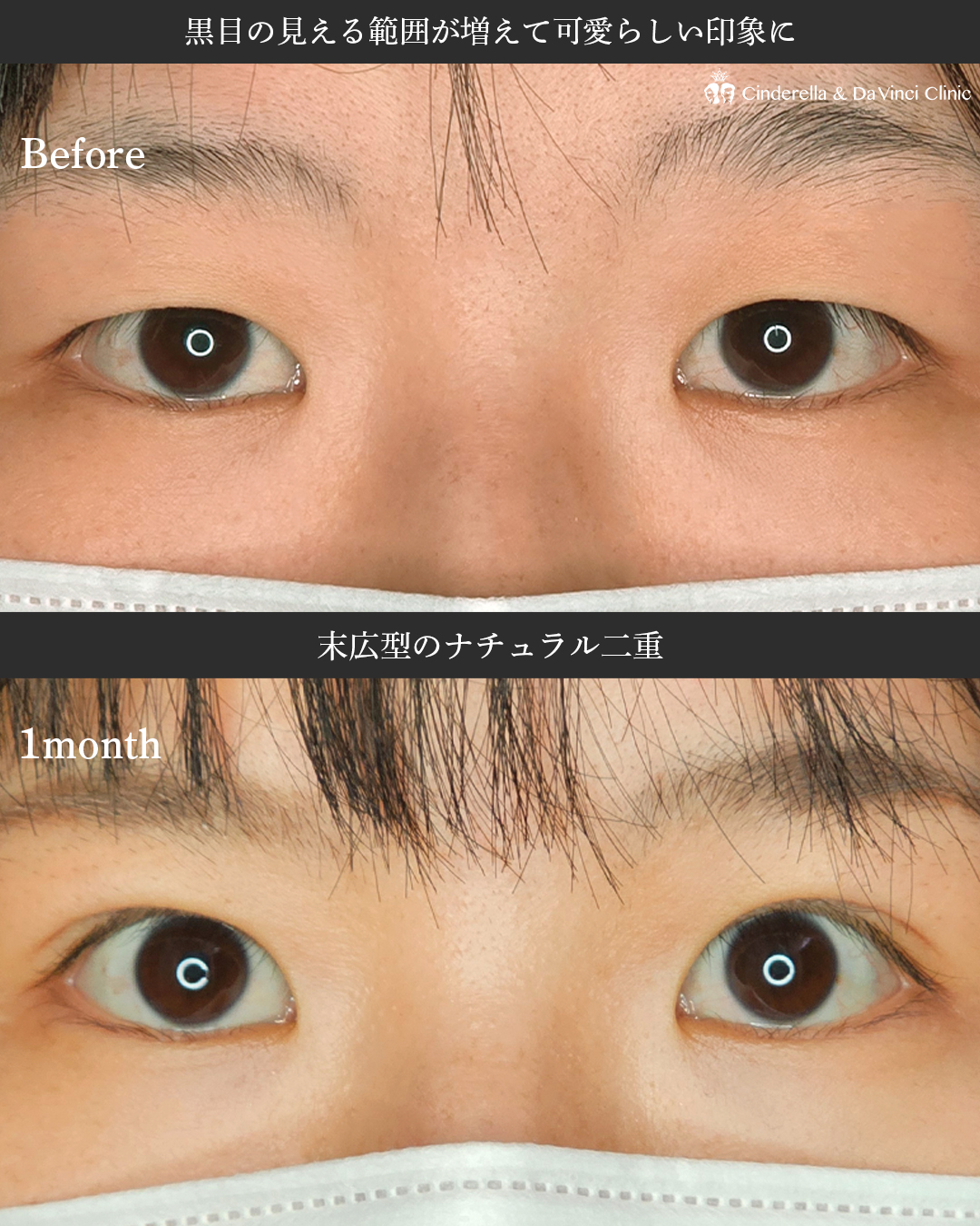 ナチュラル二重の画像