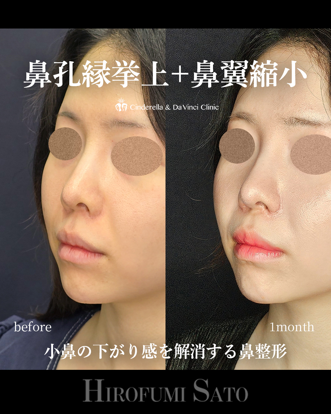 鼻の見え方を変えるの画像