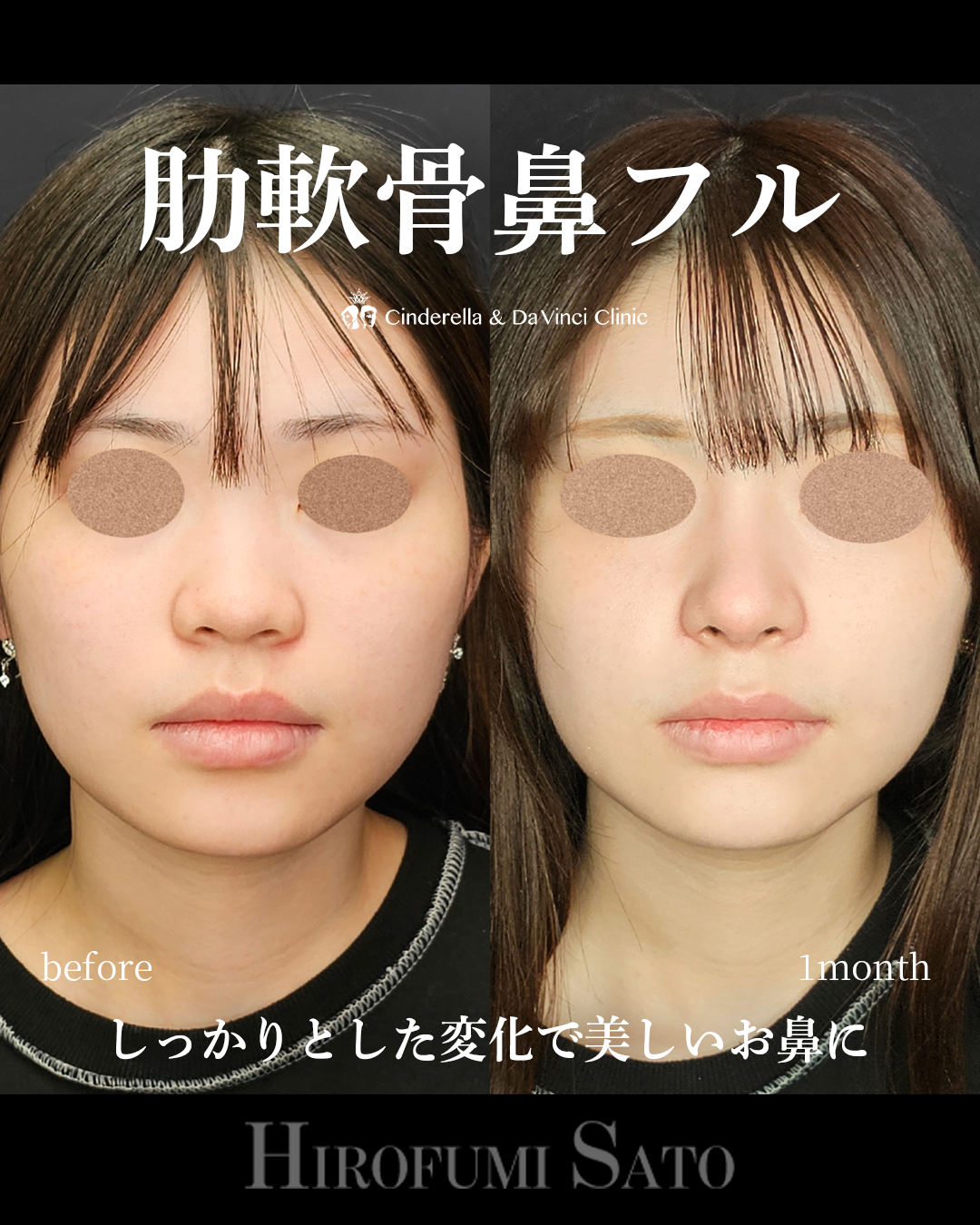 肋軟骨鼻フルの画像