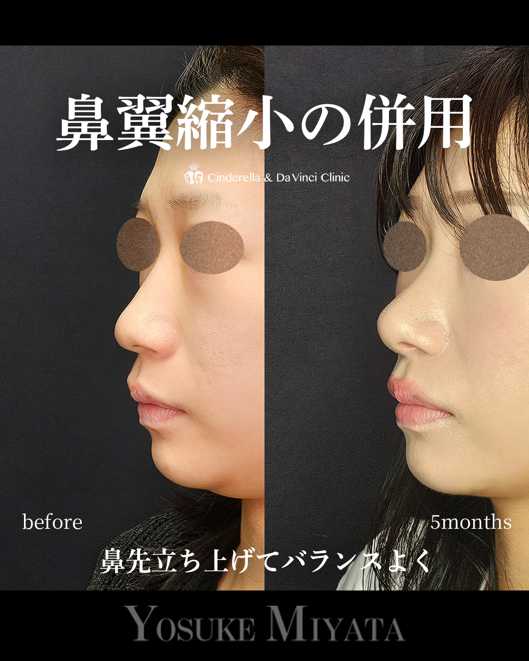 鼻の広がりを抑えるの画像