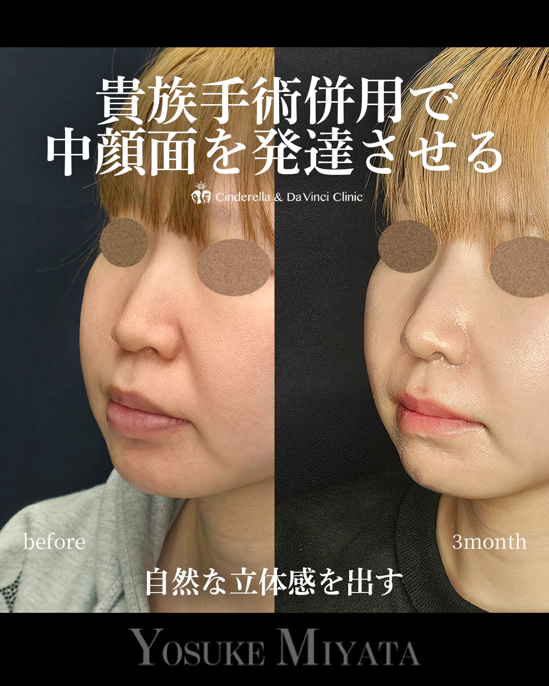 自然な立体感出すの画像