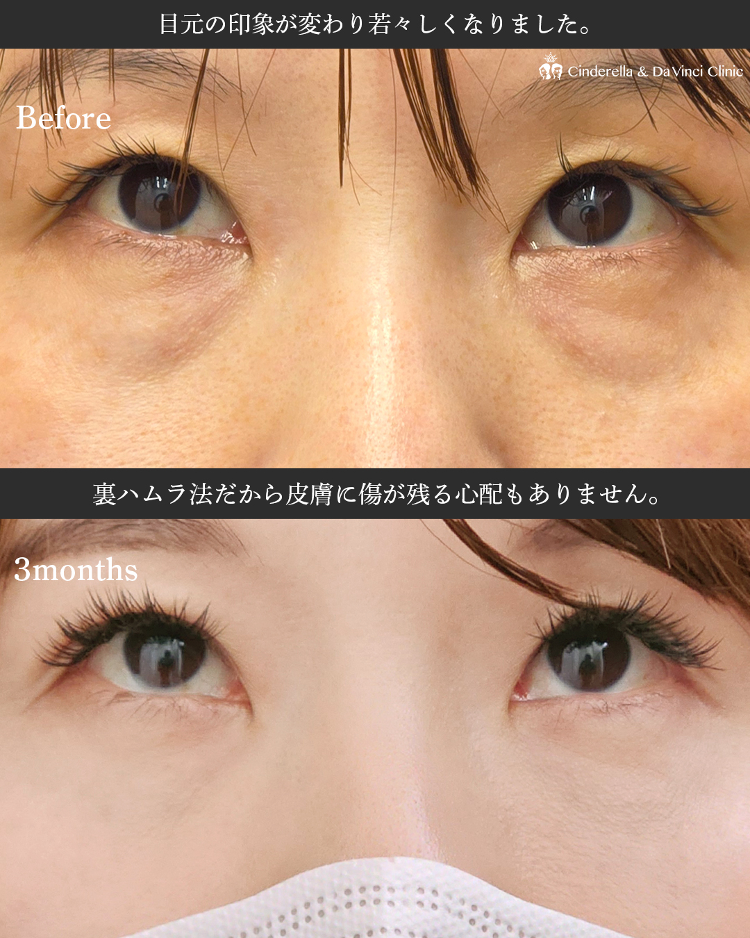 クマ取りで-10歳の画像