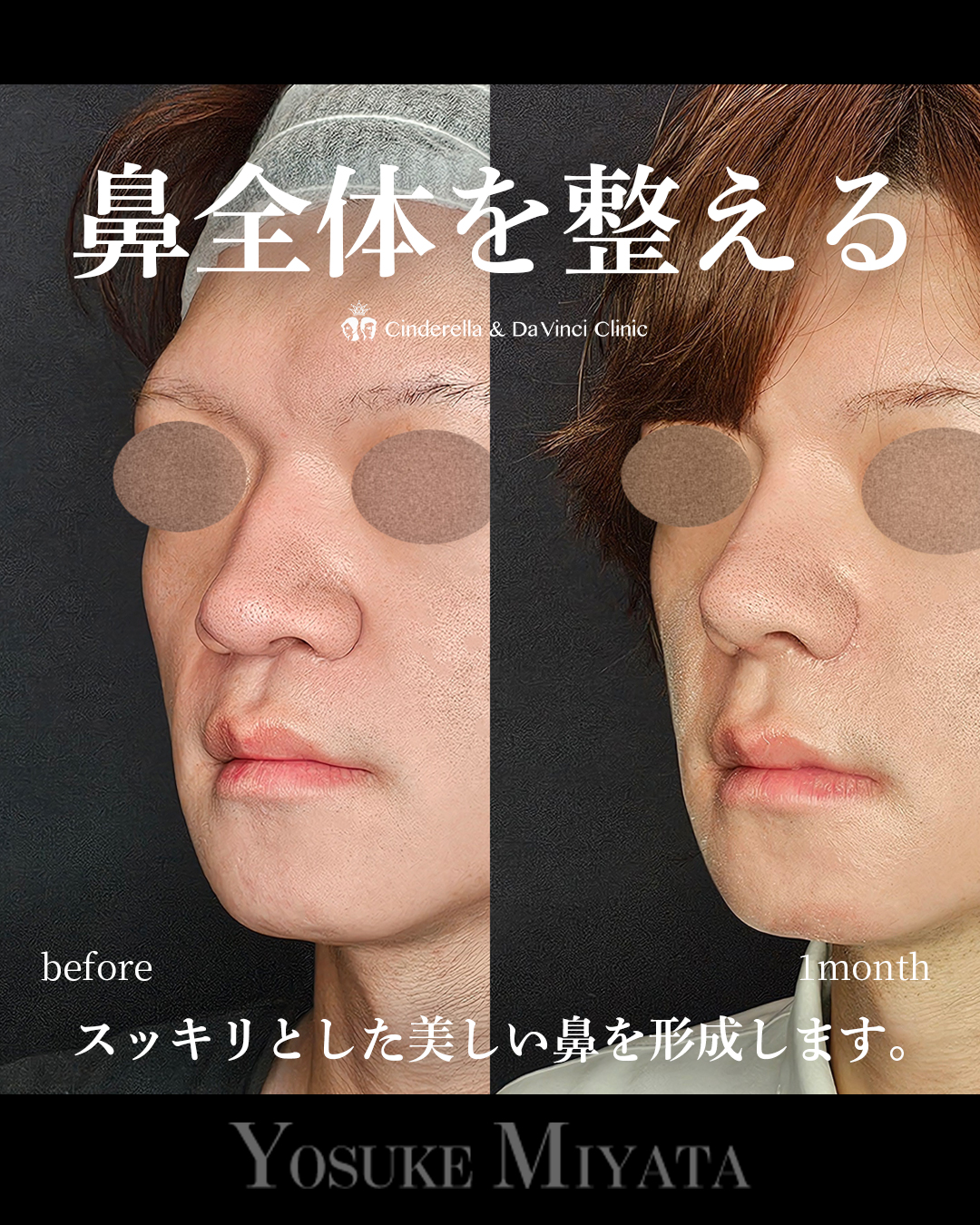 鼻全体を整えるの画像