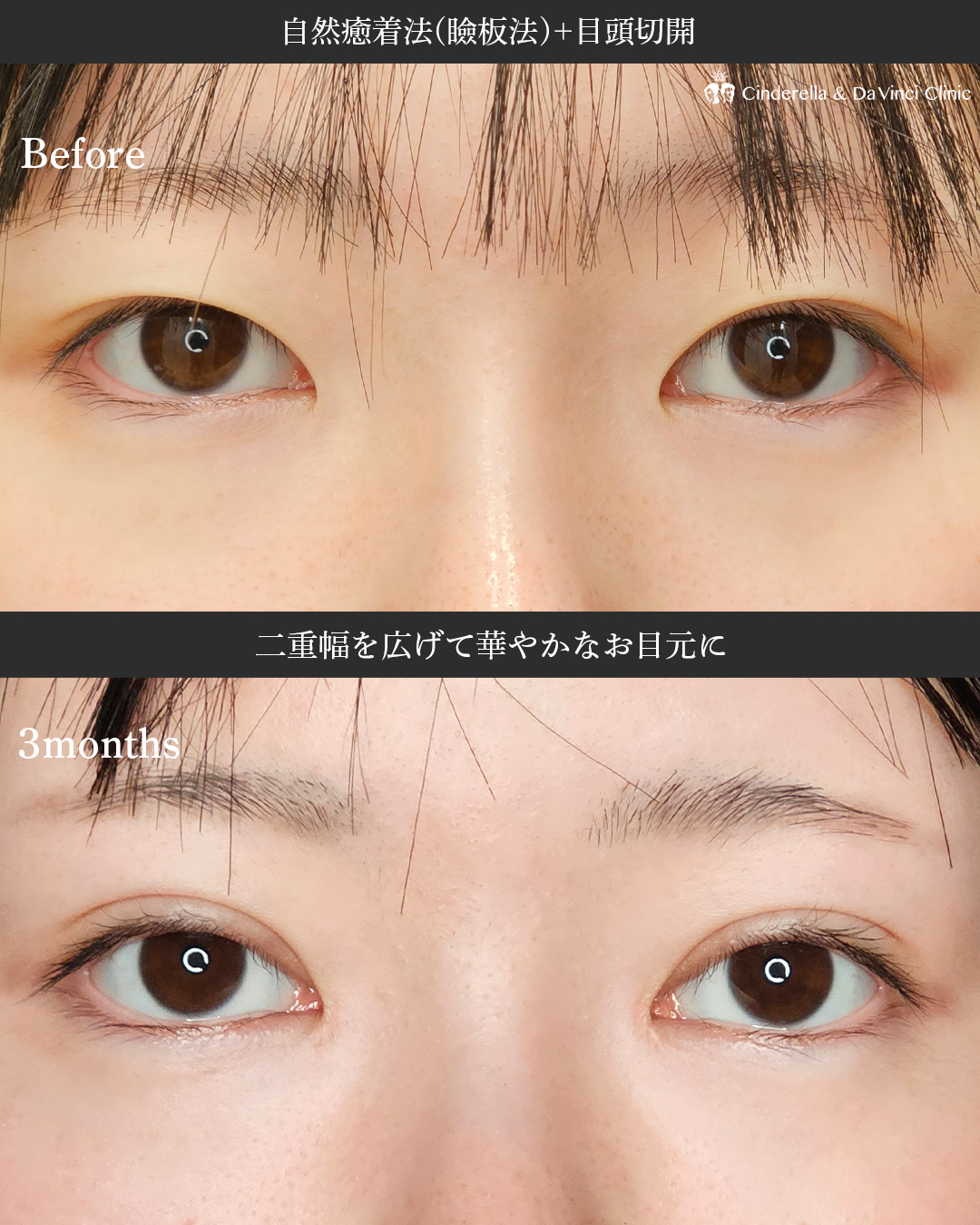 華やか二重の画像