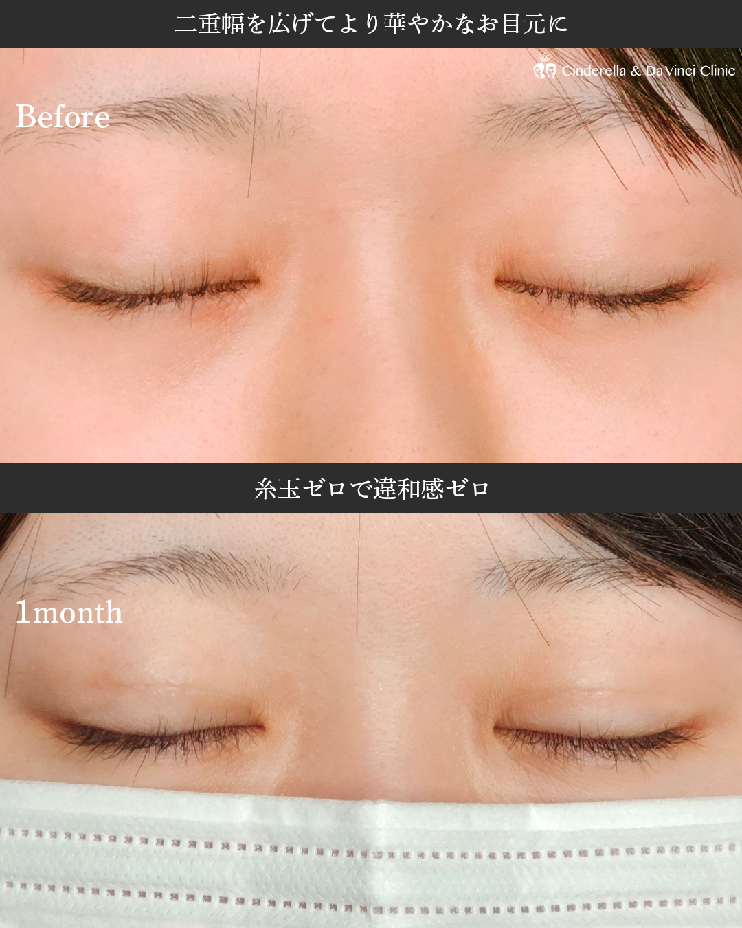 盛れる二重の画像
