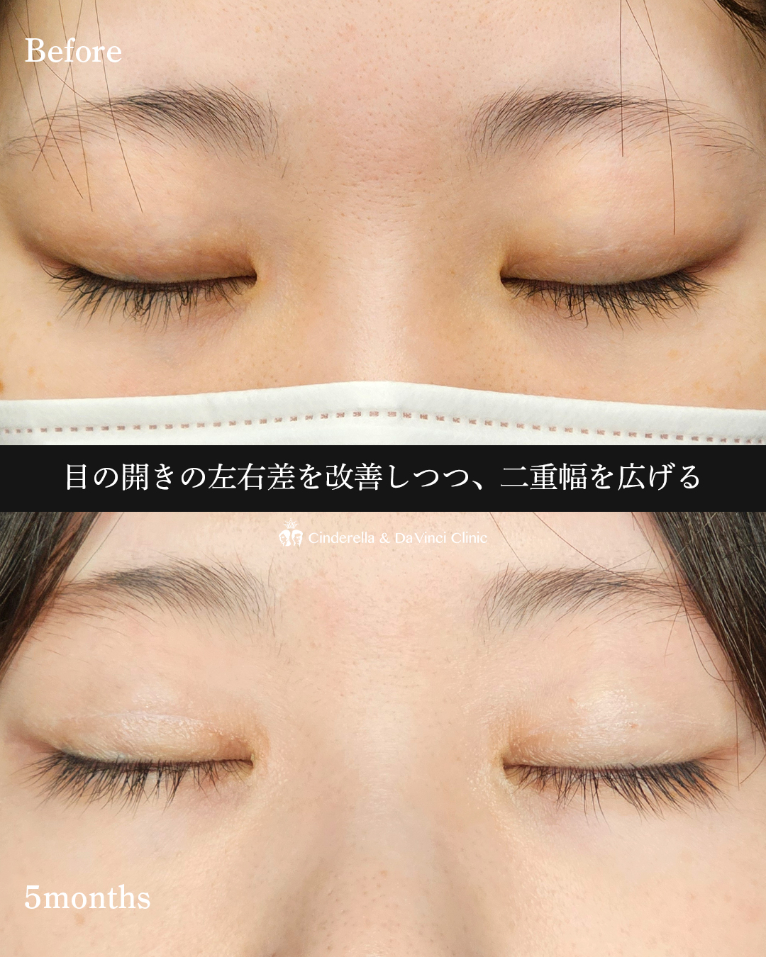 目の開きをよくするの画像