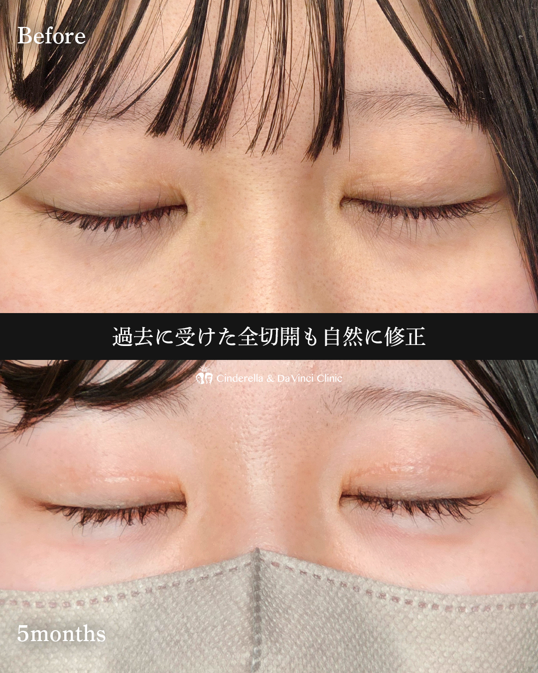 二重全切開の修正の画像