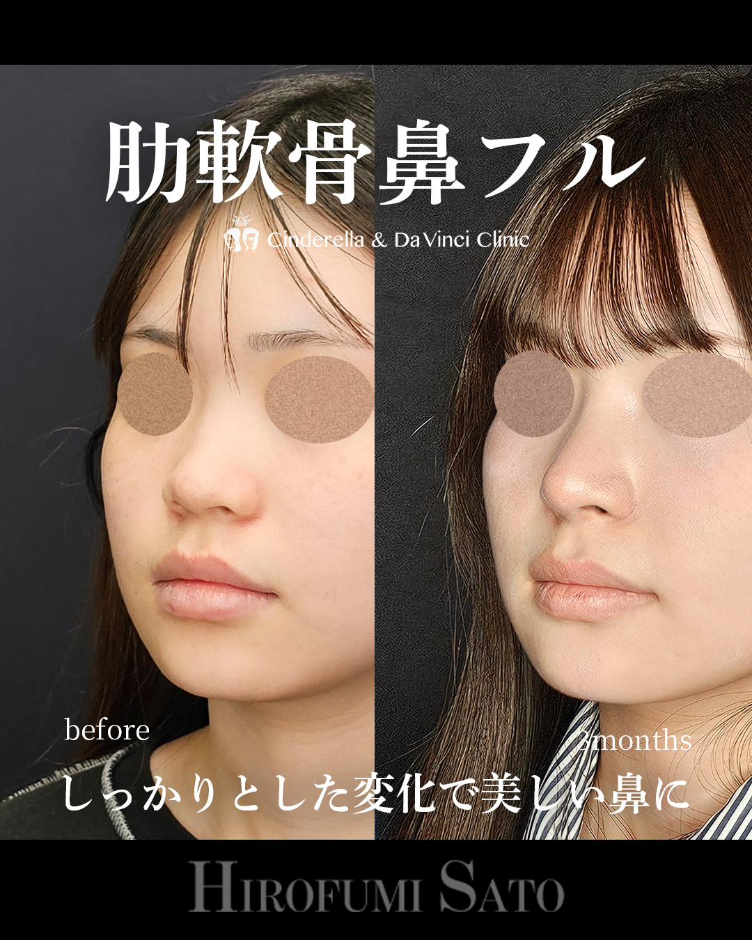肋軟骨鼻フルの画像