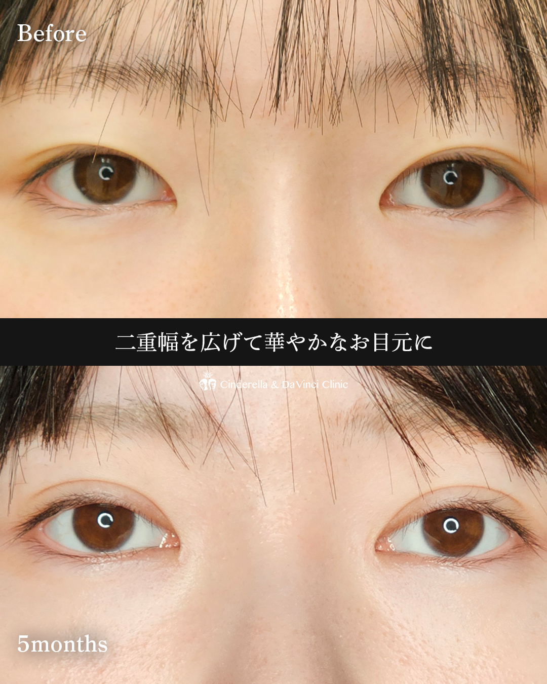 華やか二重の画像