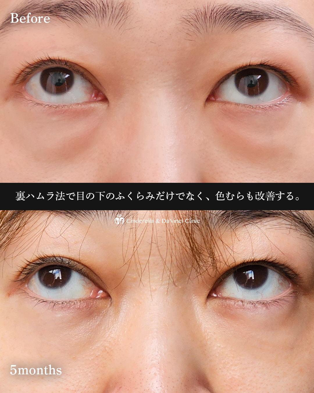 目の下の色ムラ改善の画像