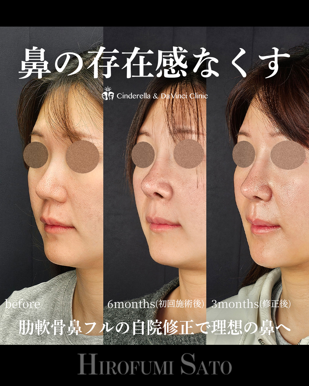 鼻全体を整えるの画像