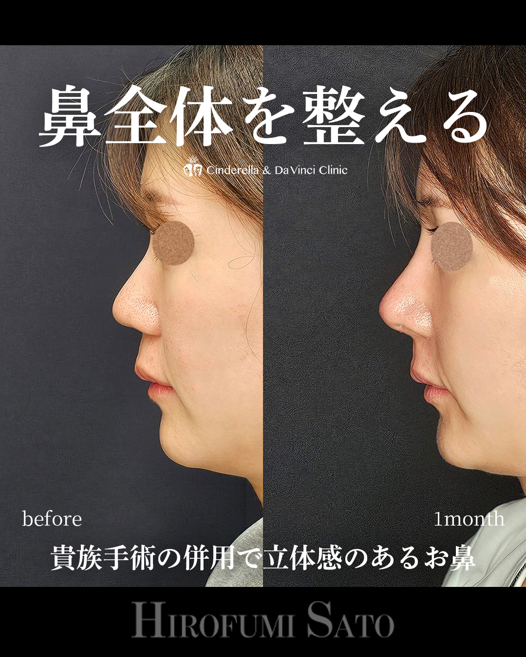 鼻全体を整えるの画像