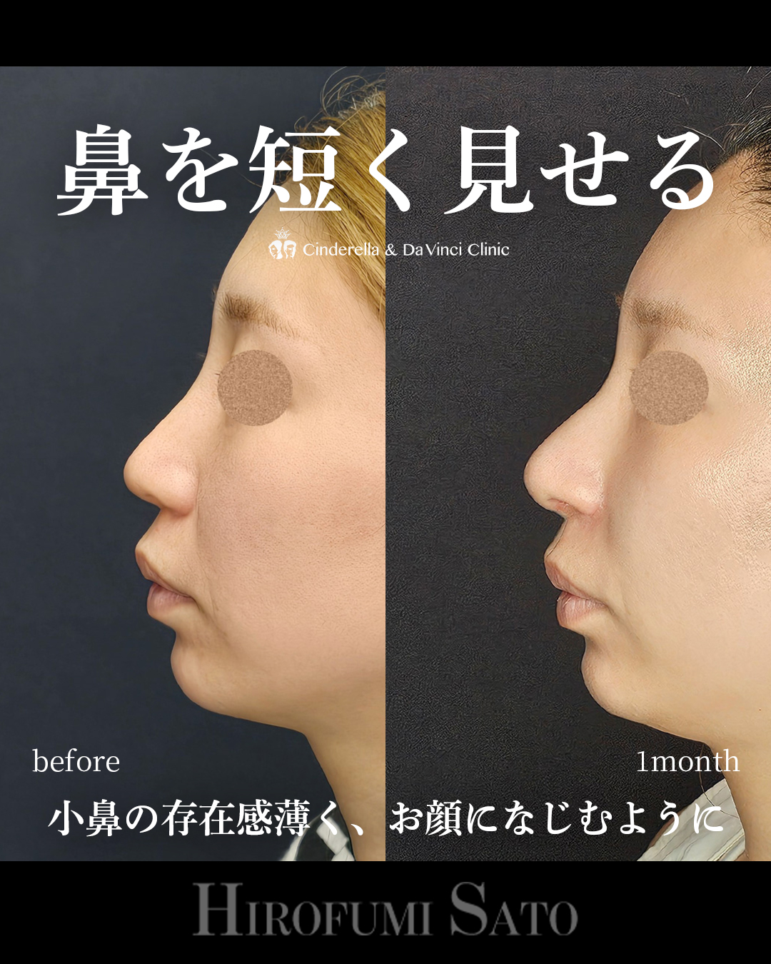 鼻を短く見せるの画像