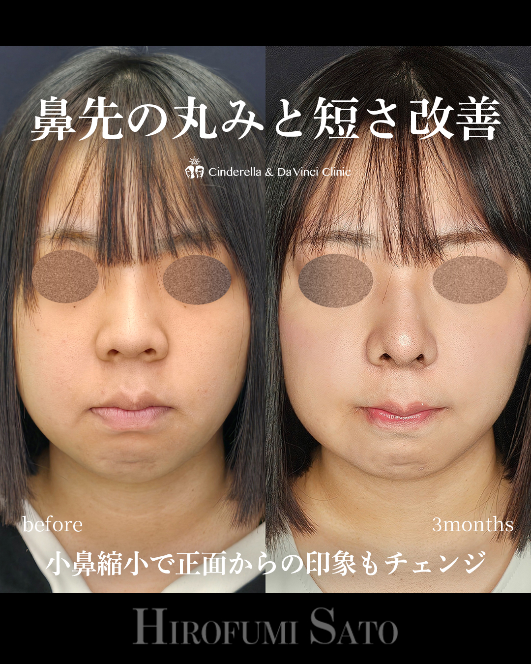 鼻先の丸み改善の画像