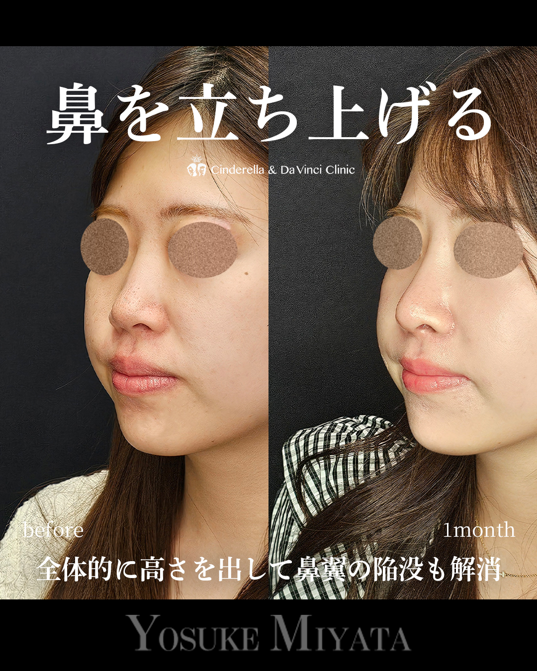 鼻を立ち上げるの画像