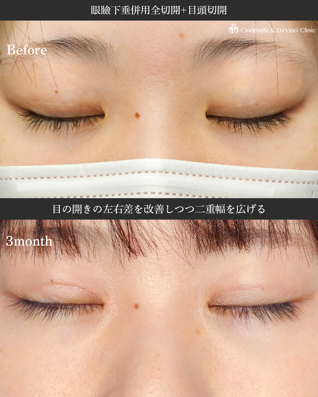 目の開きをよくするの画像