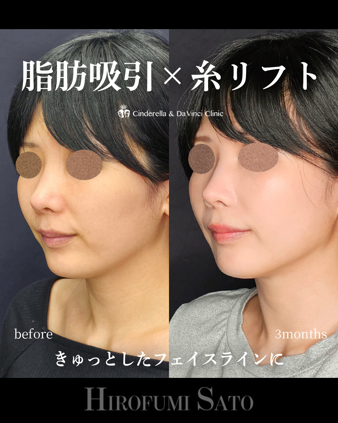 脂肪吸引と糸リフトの画像