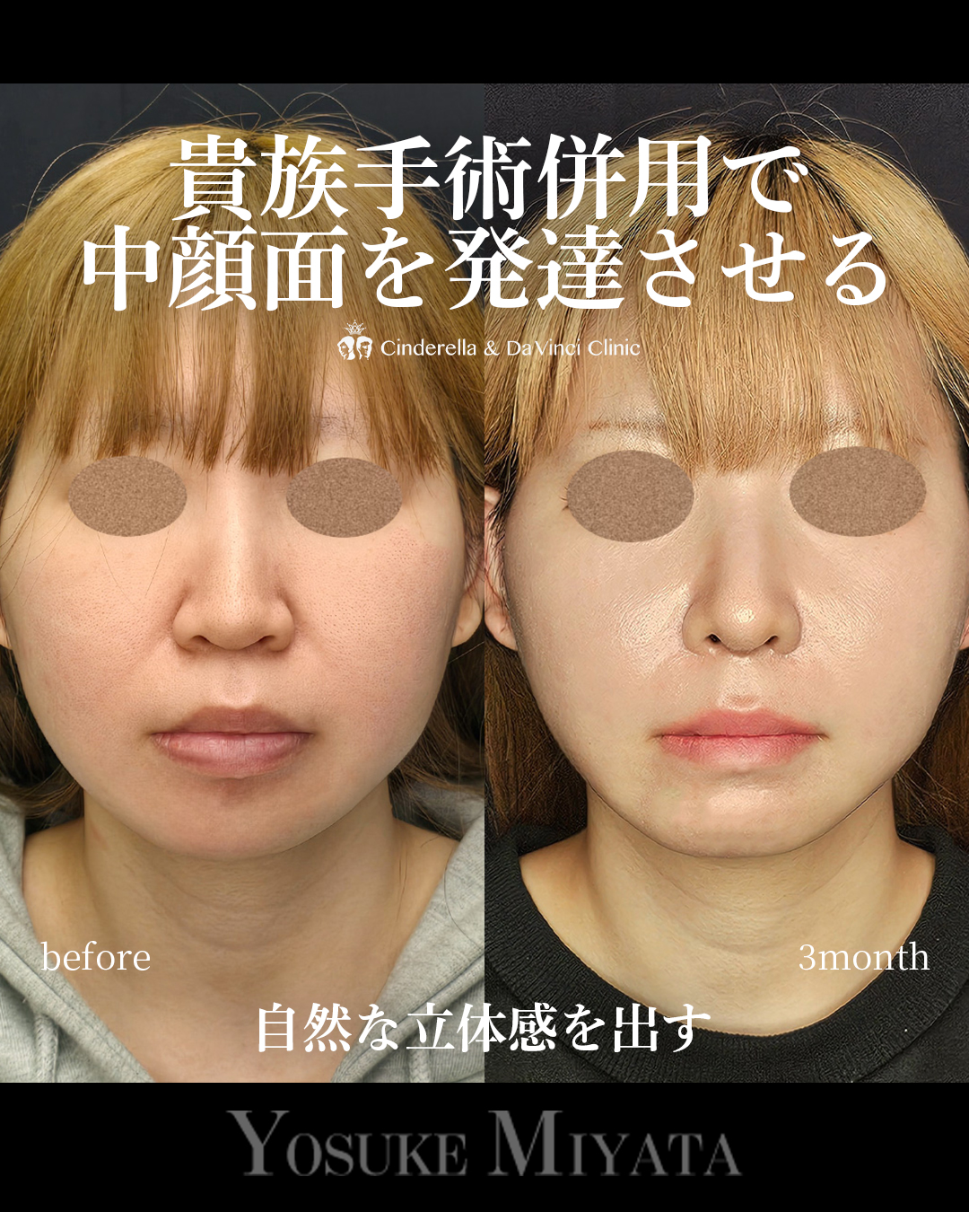 自然な立体感出すの画像