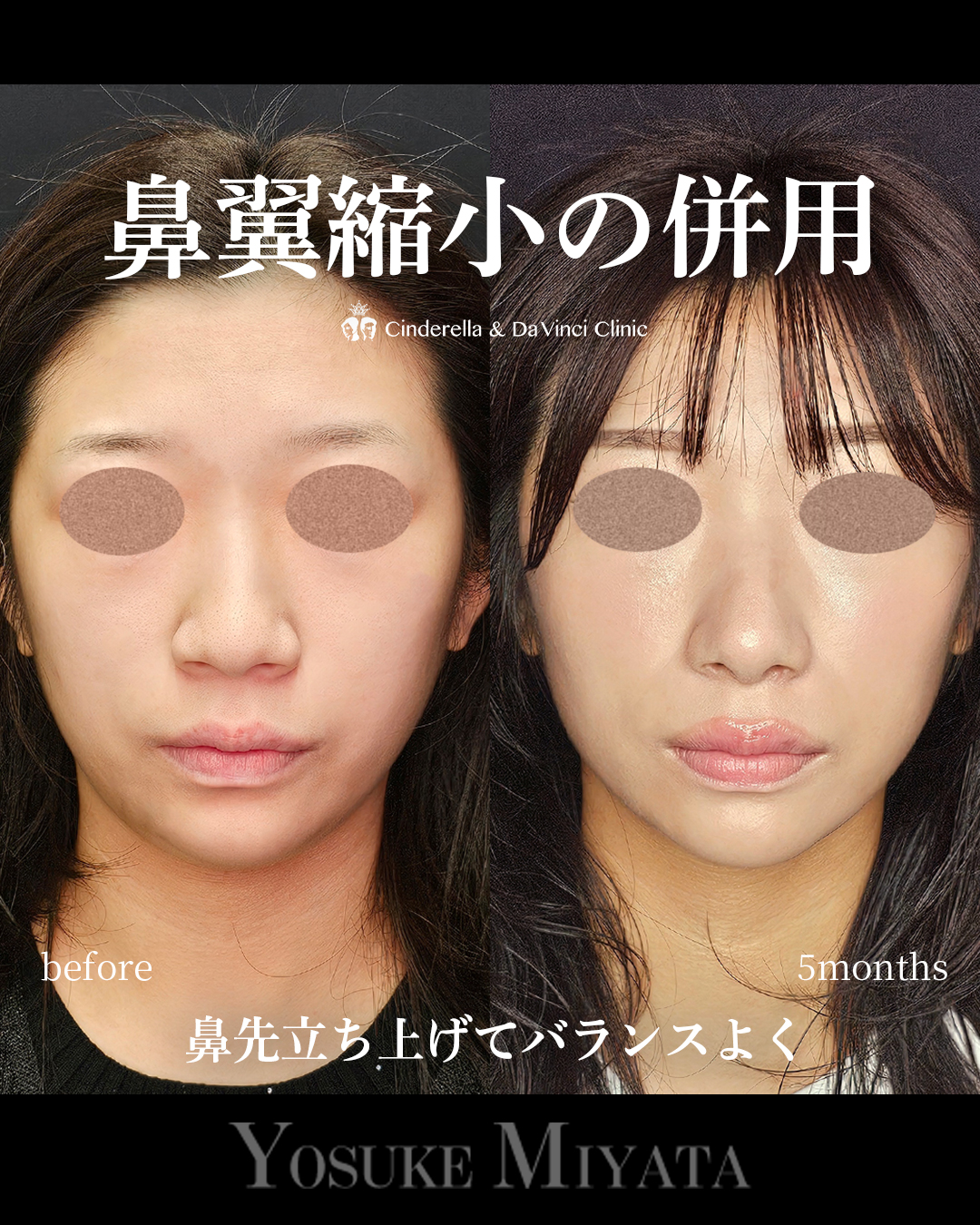 鼻の広がりを抑えるの画像