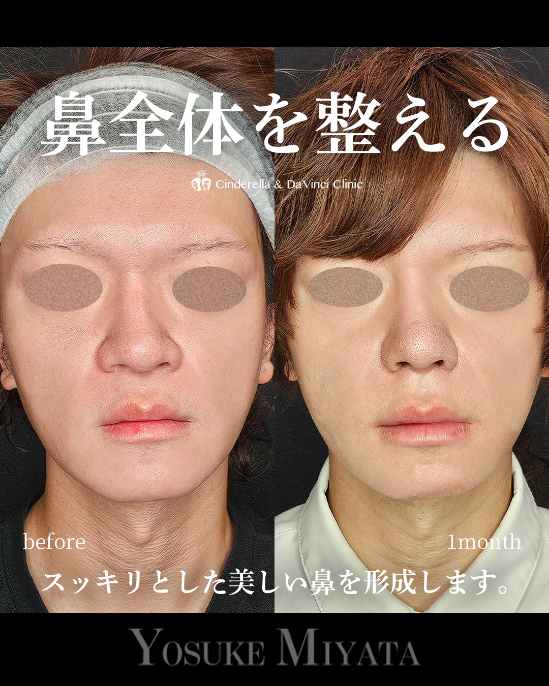 鼻全体を整えるの画像