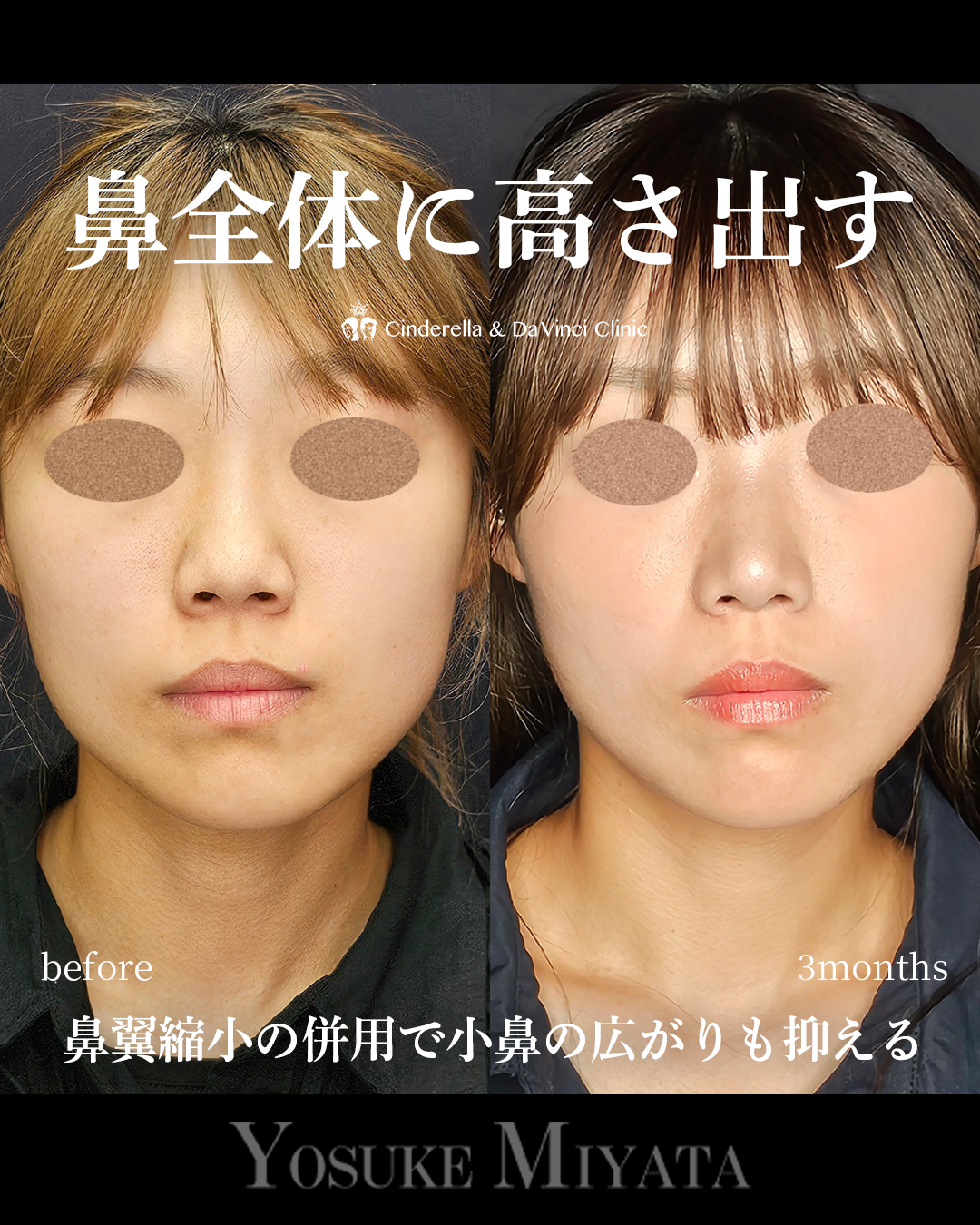 鼻全体に高さ出すの画像