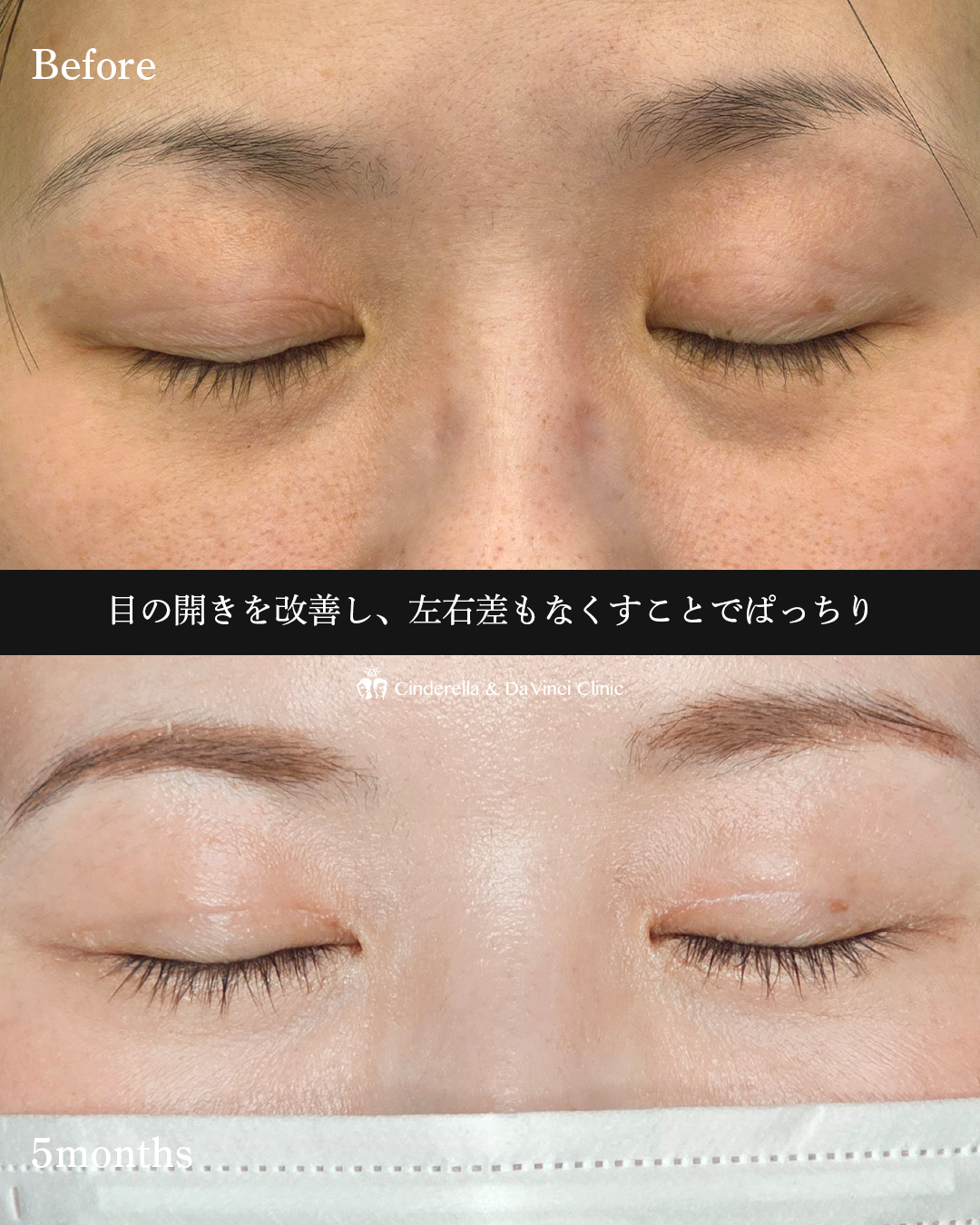 眼瞼下垂手術の画像