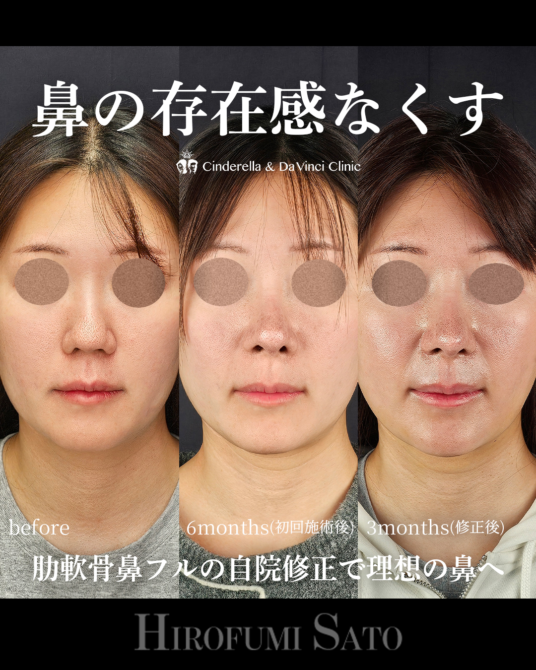 鼻全体を整えるの画像