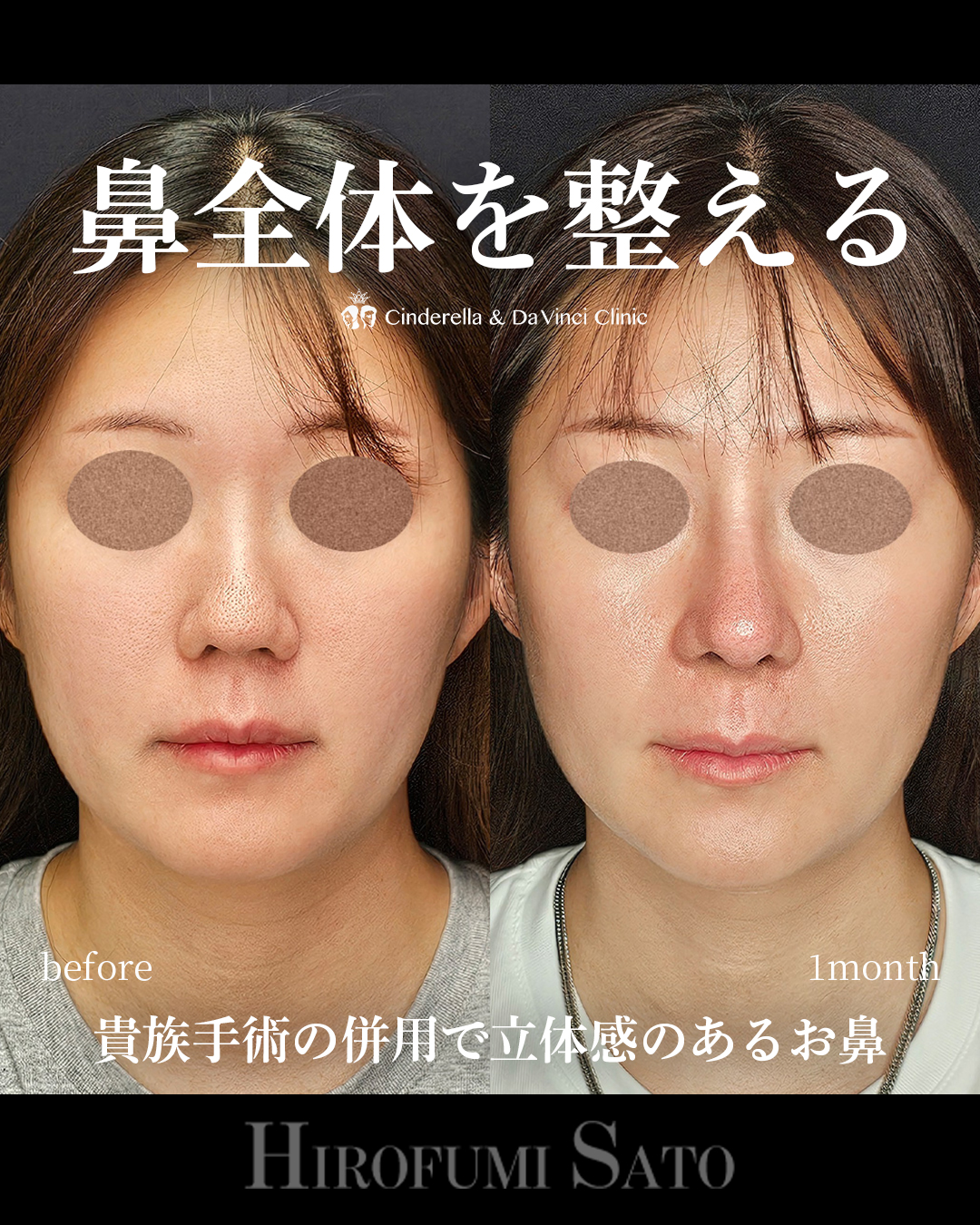鼻全体を整えるの画像