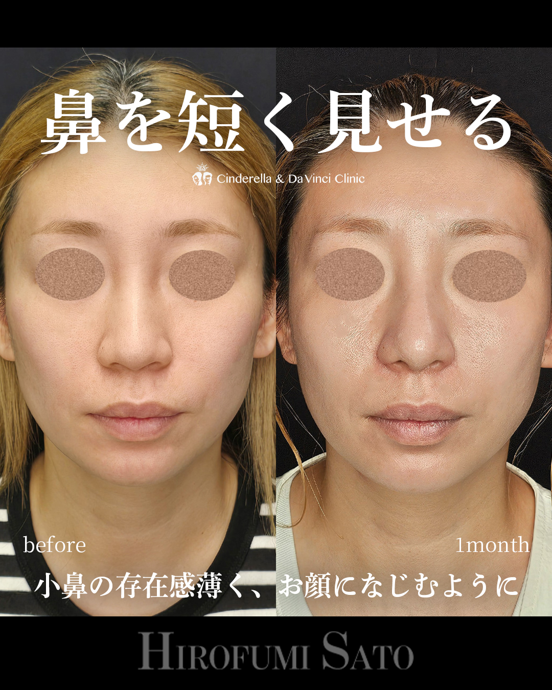 鼻を短く見せるの画像