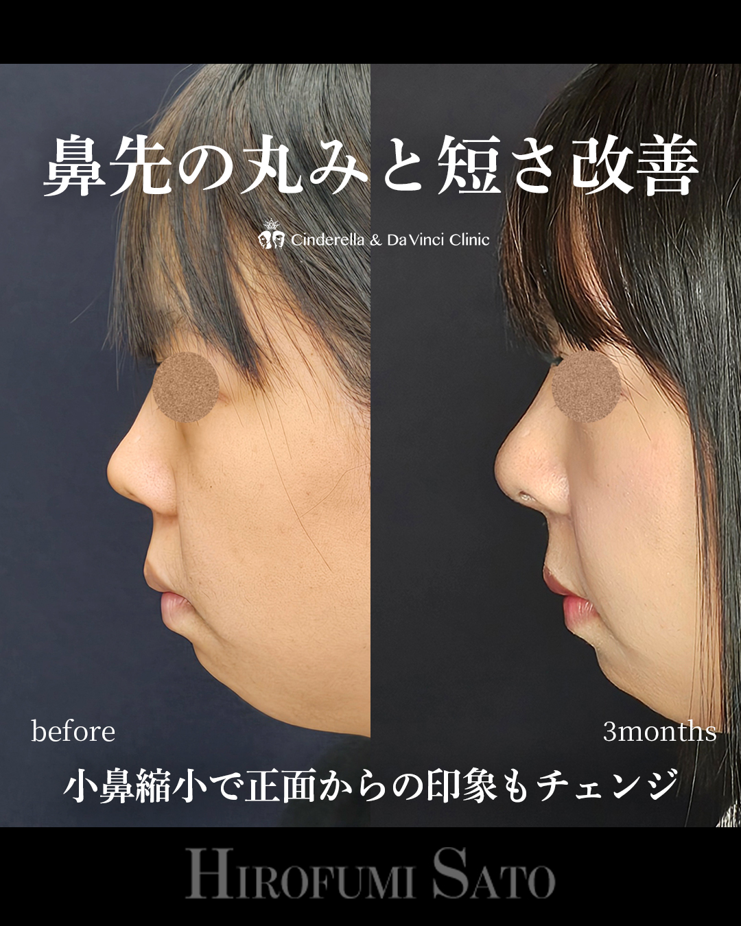 鼻先の丸み改善の画像