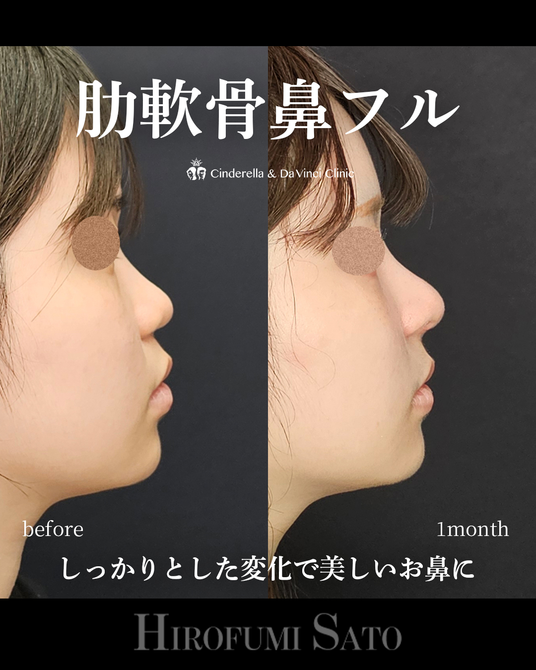肋軟骨鼻フルの画像
