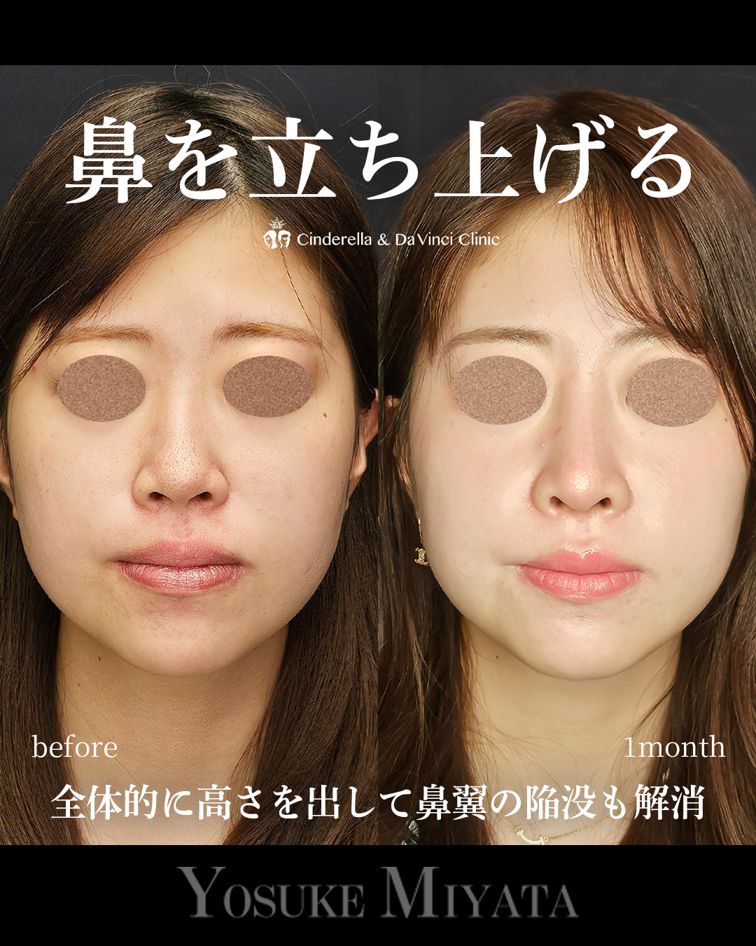 鼻を立ち上げるの画像