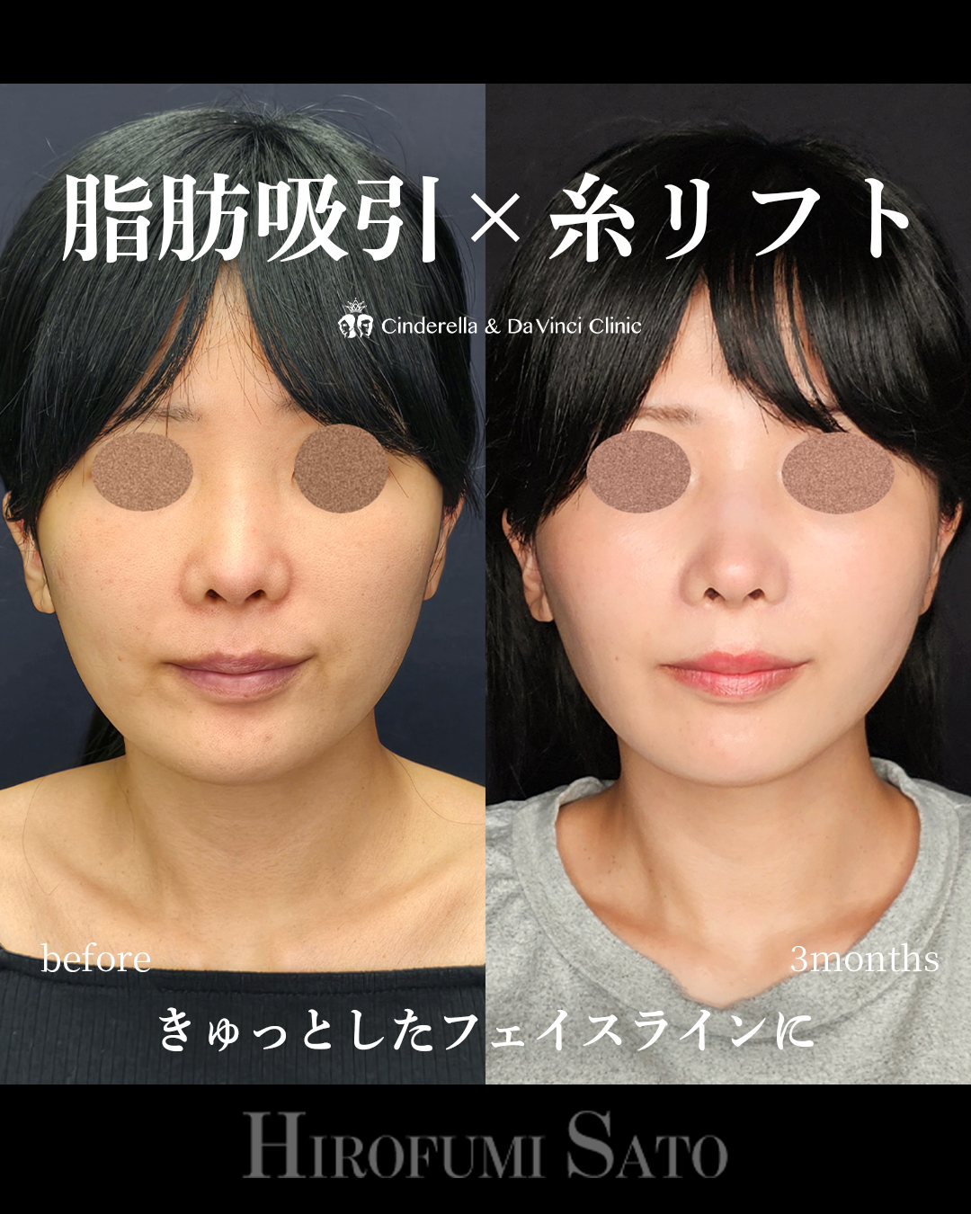 脂肪吸引と糸リフトの画像
